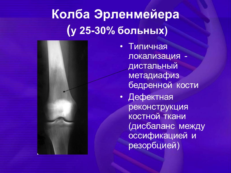 Колба Эрленмейера  (у 25-30% больных) Типичная локализация - дистальный метадиафиз бедренной кости Дефектная